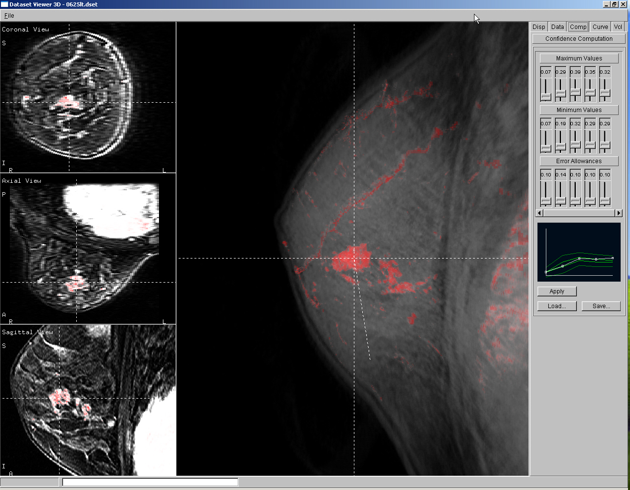 Ductal Cancer (MRI)