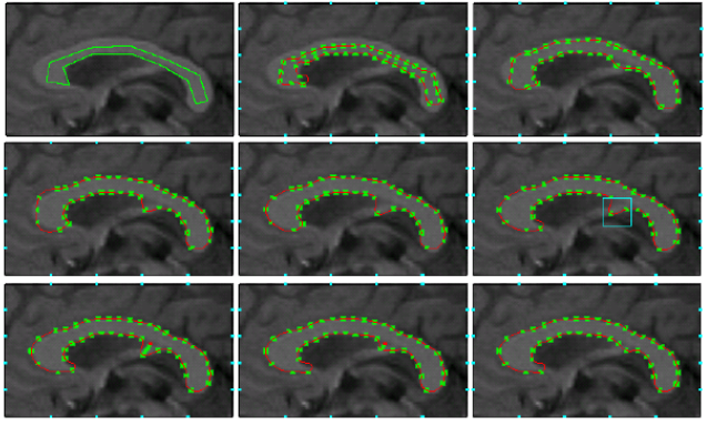 Corpus Callosum Segmentation Using Implicit Representation