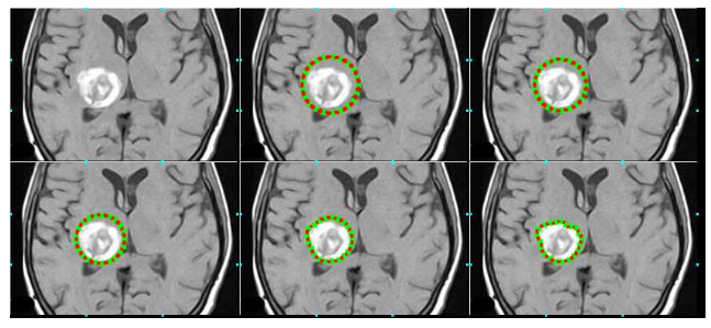 Tumor Segmentation Using Implicit Representation